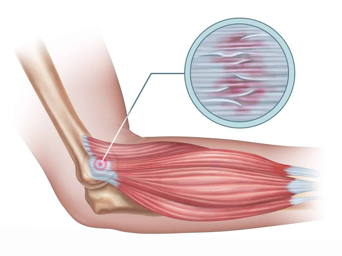 Tennis elbow diagram showing a detail of the damaged tendon tissue. Digital illustration.